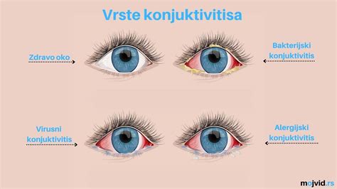 Slika različnih vrst konjunktivitisa: virusni, bakterijski, alergijski