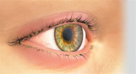 Ilustracija veke z znaki blefaritisa: rdečina, luske na trepalnicah