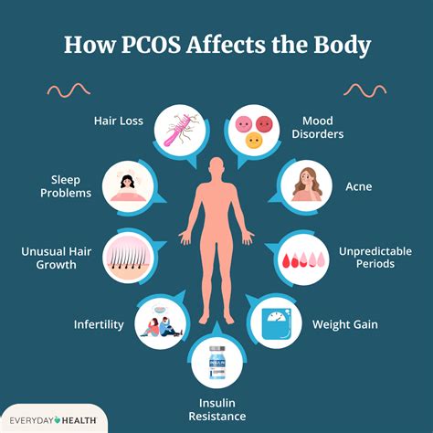 Infografika s prikazom pogostih simptomov PCOS