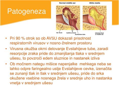 ilustracija človeškega ušesa z vnetjem srednjega ušesa