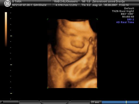 3D ultrazvočna slika obraza dojenčka v maternici