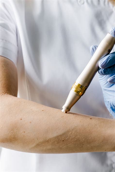 Pred in po abdominoplastiki - prikaz učinkov odstranitve odvečne kože