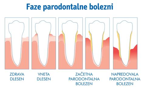 Ilustracija zdrave dlesni v primerjavi z vneto dlesnijo