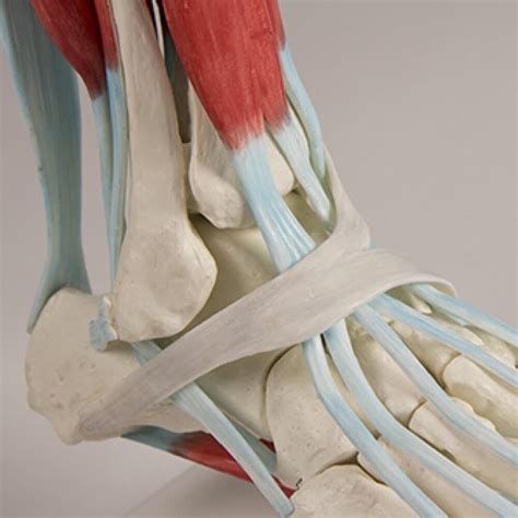 stopalo z plantarnim fibromom