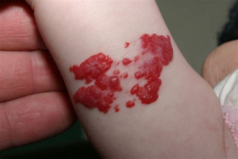 Infantilni hemangiom