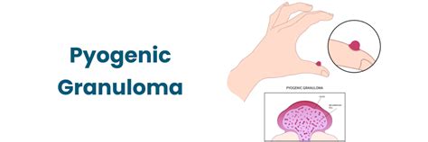 Prikaz piogenega granuloma na dlesni nosečnice