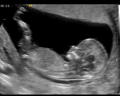 Nosečnica ki čuti premike otroka v trebuhu