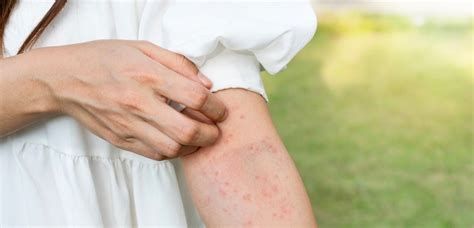 Otrok z vročinskimi izpuščaji na koži