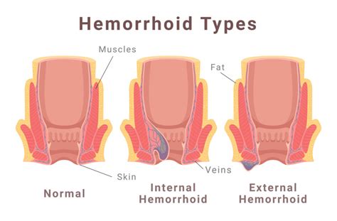 Diagram analne razpoke in hemoroidov