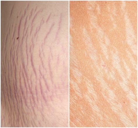 Strije na trebuhu med nosečnostjo