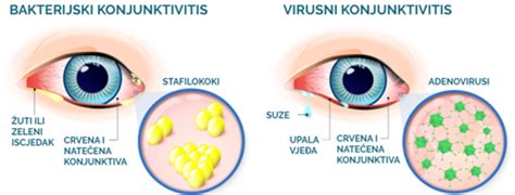 Otrok s konjunktivitisom