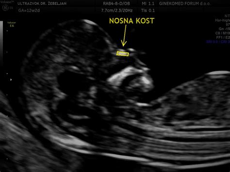 Prikaz meritve nuhalne svetline na ultrazvočnem zaslonu