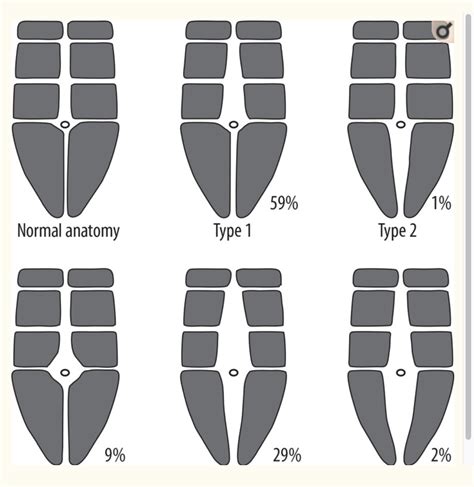slika trebušnih mišic z označenim razmikom