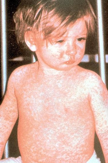 Dojenček z rdečim izpuščajem na telesu