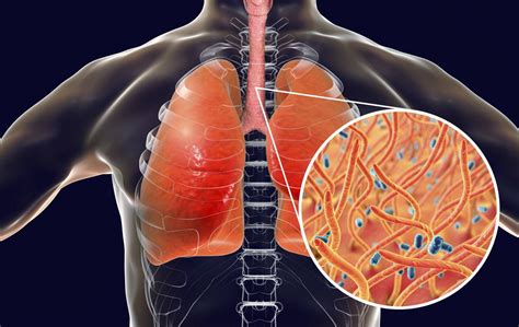 Ilustracija bakterije Bordetella pertussis, ki povzroča oslovski kašelj