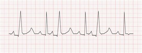 Diagram petih parametrov Apgarjevega testa