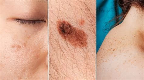 Različne vrste materinih znamenj na koži