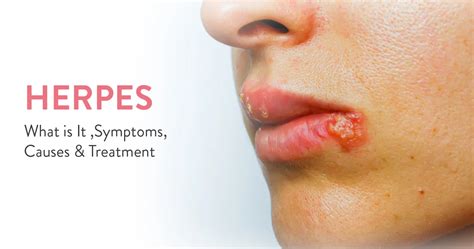 Simptomi herpesa