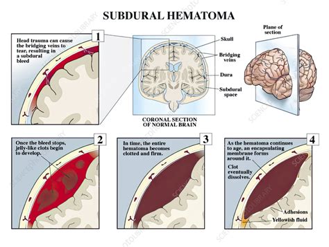 Diagram prikazuje lokacijo subhorionskega hematoma med horionom in maternično steno