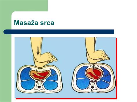 Shema masaže srca pri dojenčku