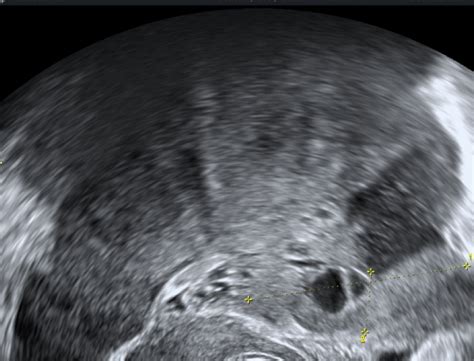 Ultrazvok jajčnikov med IVF postopkom