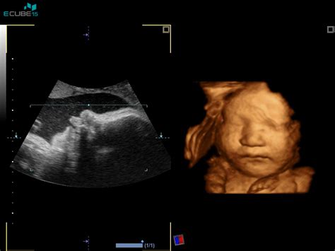 Ultrazvok ploda z označenim cističnim higromom