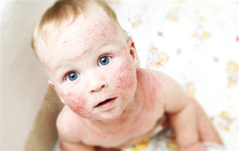 kožni izpuščaj pri dojenčku