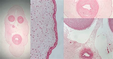 Endometrioza pod mikroskopom