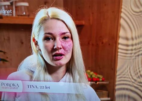 Rdečkasto ognjeno znamenje na obrazu otroka