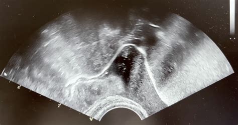 Ultrazvočni prikaz jajcevodov med HyCoSy