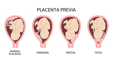 Diagram različnih vrst placente previa