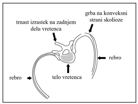 Otrok izvaja Adamsov test za prepoznavanje skolioze