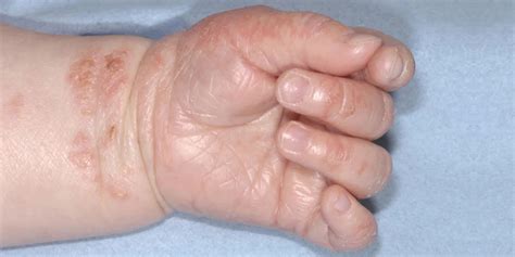 Atopijski dermatitis na rokah