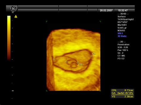 Ultrazvočni prikaz gestacijske vrečke v zgodnji nosečnosti