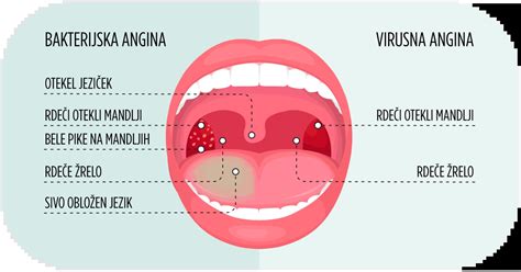Infografika o razlikah med virusno in bakterijsko angino