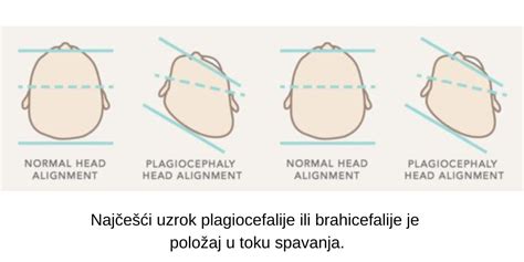 Diagram primerjave oblik glave: normalna, plagiocefalija, brahiokefalija