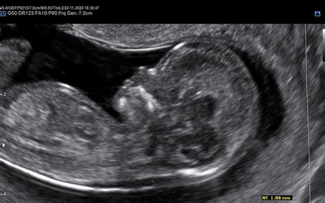 Ultrazvočni prikaz nuhalne svetline na vratu ploda