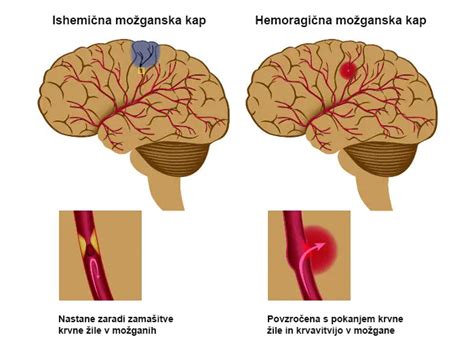 Diagram prikazuje možganske krvne žile z označenimi območji, kjer lahko pride do migrene