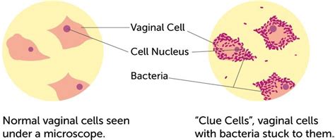 Diagram bakterijske vaginoze
