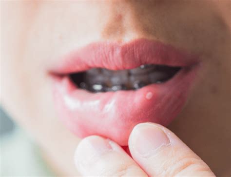 Ilustracija otroka z belimi lisami v ustih