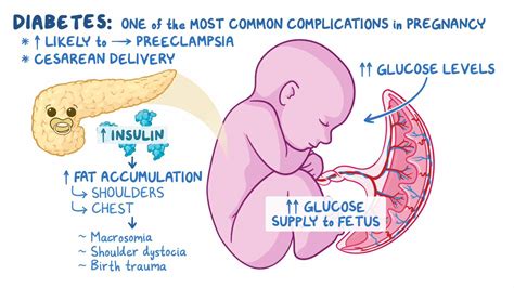 Infografika z diagramom poteka presejalnega testa za gestacijski diabetes