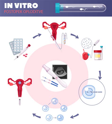 Diagram postopka umetne oploditve, ki prikazuje stimulacijo jajčnikov, odvzem jajčnih celic, oploditev v laboratoriju in embriotransfer