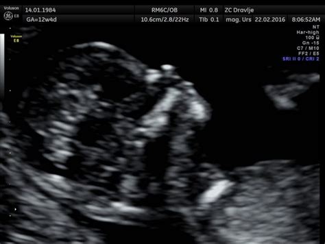 Ultrazvočni prikaz nuhalne svetline pri plodu