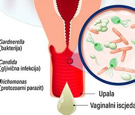 Diagram prikazuje različne vrste vaginalnih vnetij