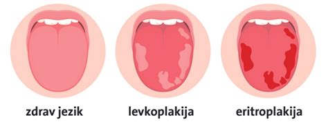 Diagram ustne votline dojenčka