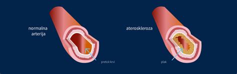Infografika, ki prikazuje povezavo med nivojem magnezija v krvi in tveganjem za srčno-žilne bolezni.