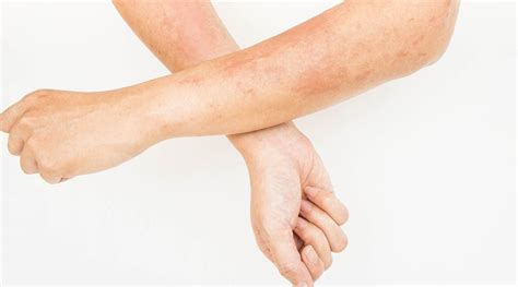 simptomi glivične okužbe bradavic