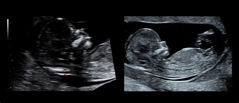 Ultrazvok nosečnice v zgodnji fazi
