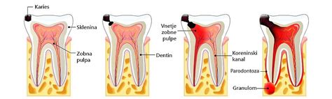 Diagram zobnega kariesa