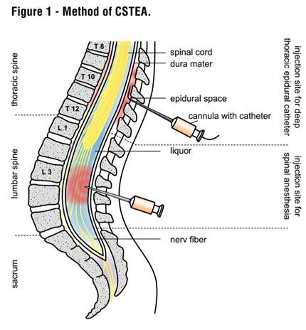 Diagram ledvene epiduralne analgezije